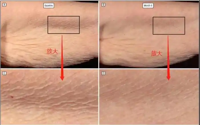 图1 视黄醇改善皮肤细纹