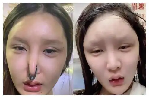 "网红失败整容照"大盘点,前后对比超惨烈,网友:根本没眼看 - 整容前后