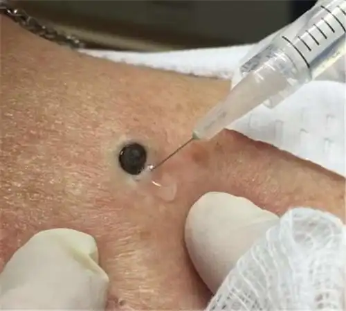 许多人自从青春期之后,黑头粉刺便常驻在鼻头上,怎麼也用不掉.