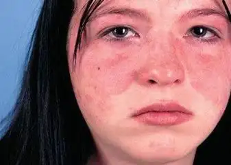 可分为盘状红斑狼疮(dle),亚急性皮肤型红斑狼疮(scle),系统性红斑