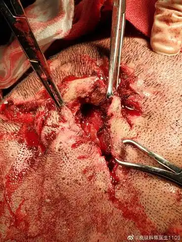 穿掘性毛囊炎手术中