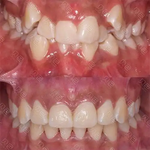 你们谁知道有虎牙的怎么矫正,不能拔!拔了会让嘴巴塌陷