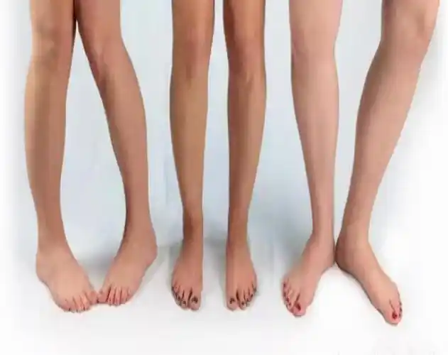 内八字,外八字孩子脚型正常不正常,家长可以这么判断