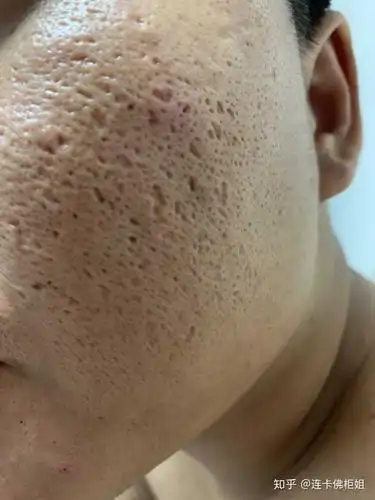 男生脸上毛孔粗大,且有黑头怎么办?