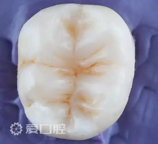 下颌第一磨牙一类洞树脂分层充填欣赏