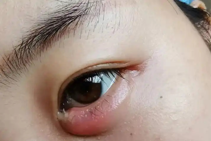 睑腺炎眼睛下方长红疙瘩图