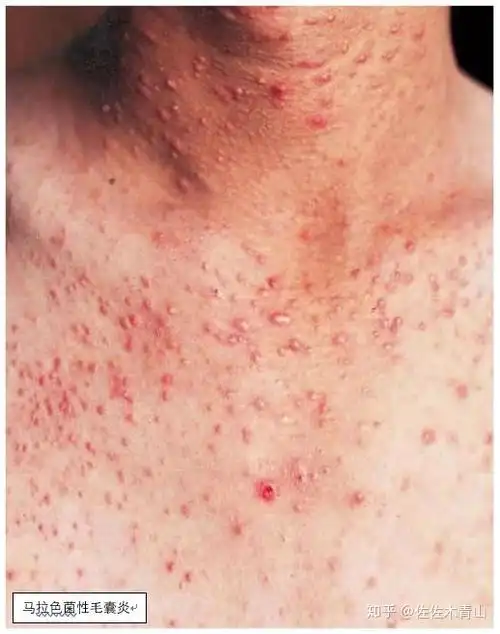 它和痤疮,细菌性毛囊炎长得其实很像,加上用药的关系,皮疹表现更难