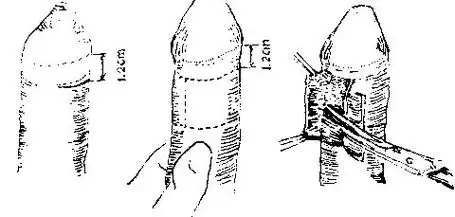激光套袖法手术治疗包皮过长包茎