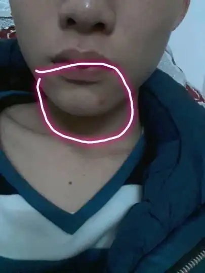 我男18岁脸上下巴长了一个硬包 能滑动的 现在明显就凸出来的 还