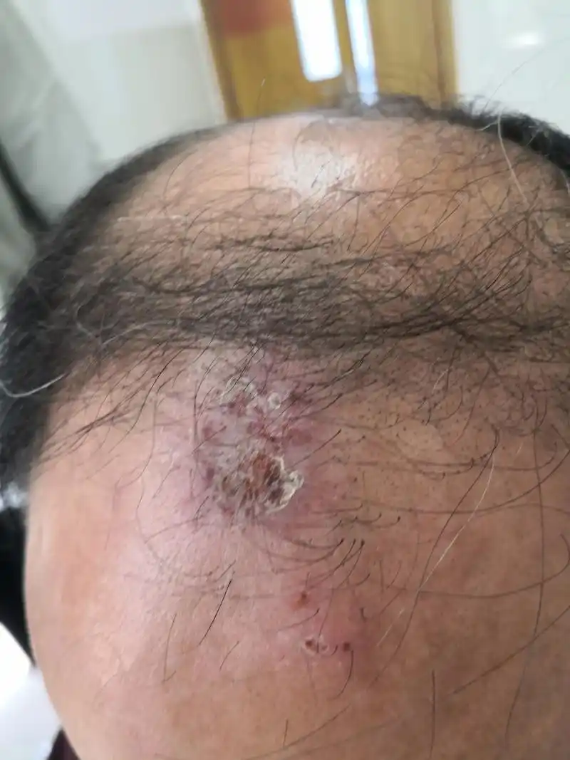 头皮破溃结痂症状.考虑湿疹症状合并感染.