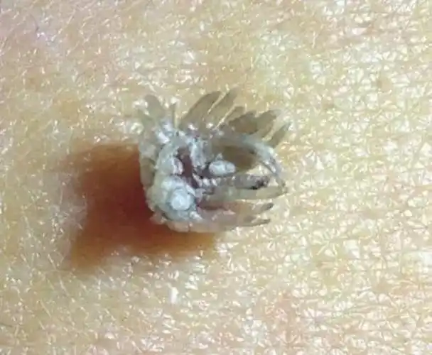 假尖锐湿疣白醋测试图片_有来医生