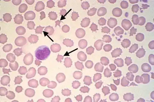 【临床基本功】红细胞异常知多少4
