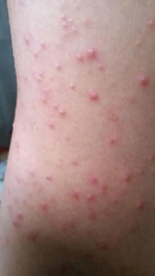 阴茎长毛囊炎的症状图片