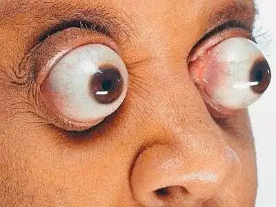 因此,近视眼尤其是高度近视会有眼球突出,眼睛变形的视觉效果.