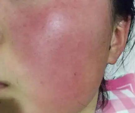 "看脸时代"冬季红血丝该怎么办?