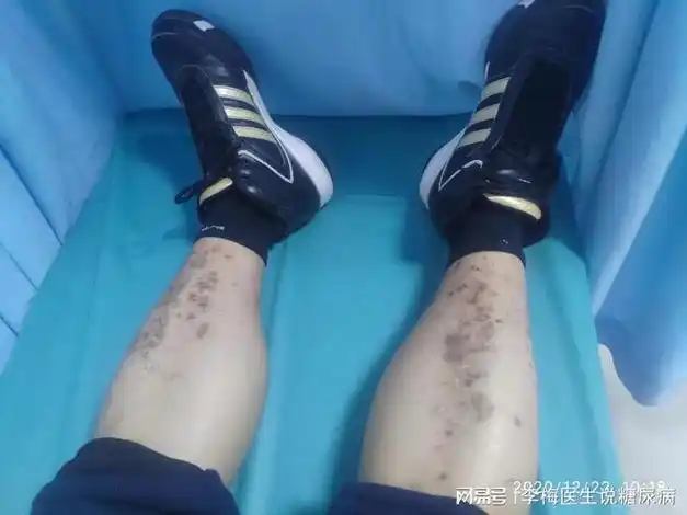 磕完了就好了,自打得了糖尿病以后磕完了就留个印"他的腿上的这个斑痕