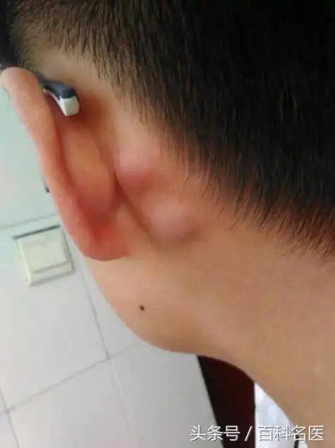 耳朵后面长了个硬包是怎么回事专家说要当心这几种情况