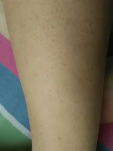 腿上好多毛孔都这样,是不是病啊