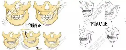下颌骨歪斜矫正手术多少钱怎么矫正效果如何会留疤吗