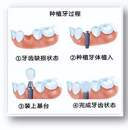 假牙|义齿|缺牙|种植牙_网易订阅