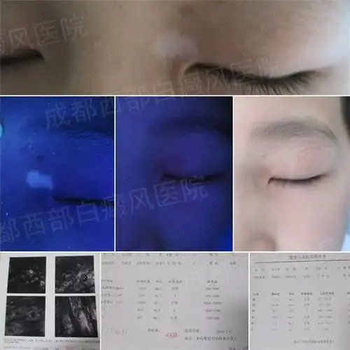 治白日记10岁男孩眼角白斑治疗周期图片对比