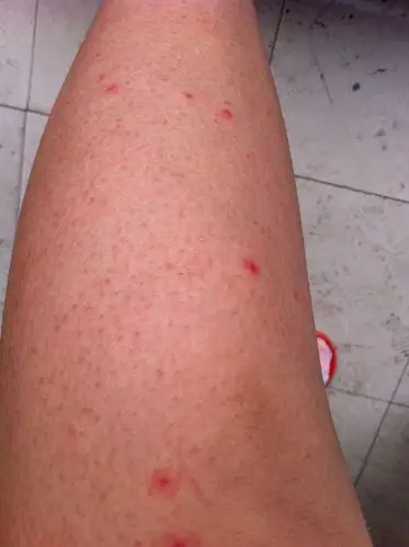 2012-07-18 为什么蚊子喜欢咬手臂和大腿 2013-09-06 身上长东西,很