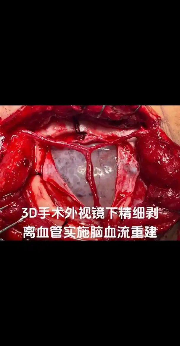 北京医院神经外科在张东教 - 抖音