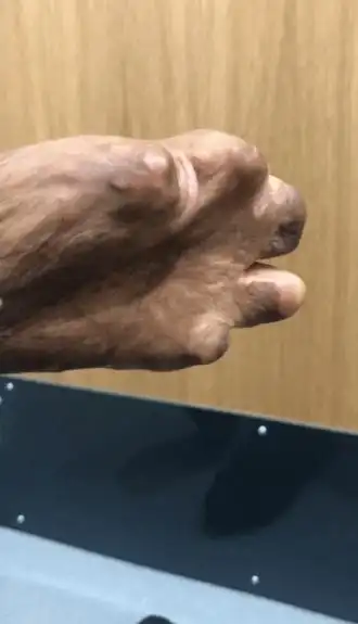 英国少女洗澡时自燃全脸毁容剩2个手指原因竟是这