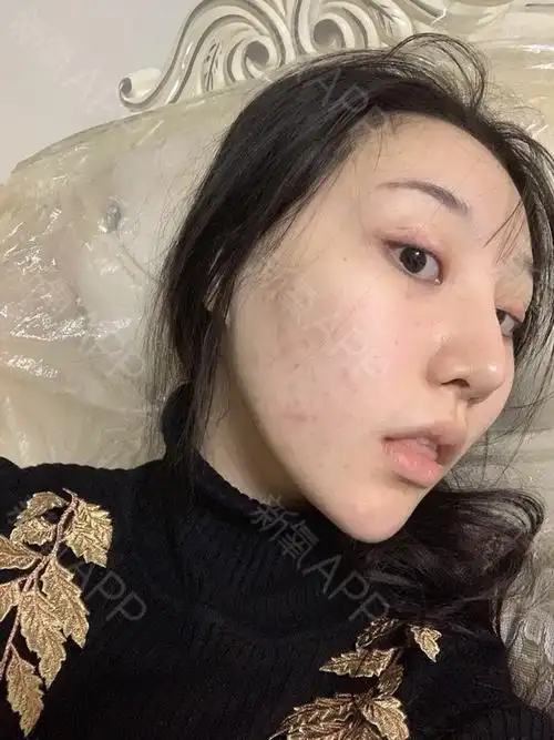 飞顿光子嫩肤激光术后第十天啦