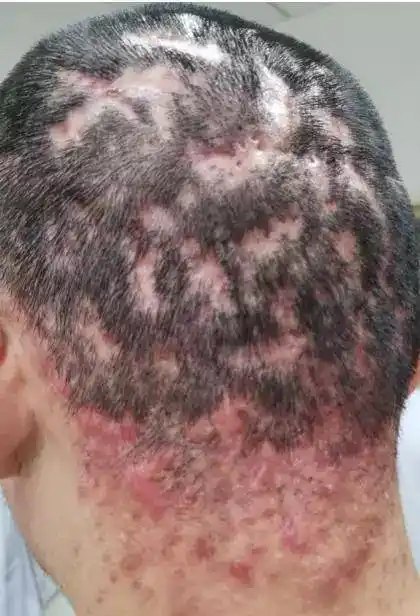 头皮反复起脓包是什么病