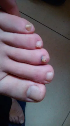 有什么问题吗?还有脚趾有变形的,是怎么回事啊?