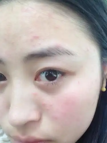 最近脸部毛孔堵塞,不通透,痘痘粉刺不断!是内分泌哪失调了吗