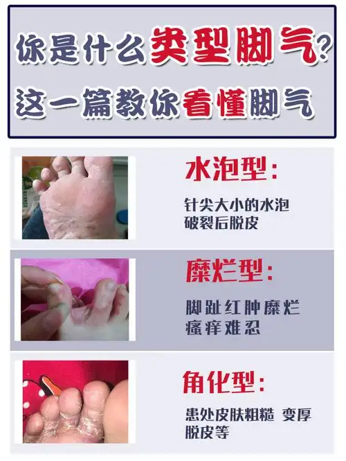 怎么治71攻略要看好看看你是哪种脚气75