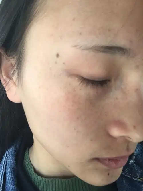 本人皮肤特别差,暗黄有班,特别恶心,要怎能去掉啊,看图
