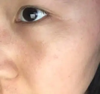 原来脸上闭口挺多的,现在看着好多了.