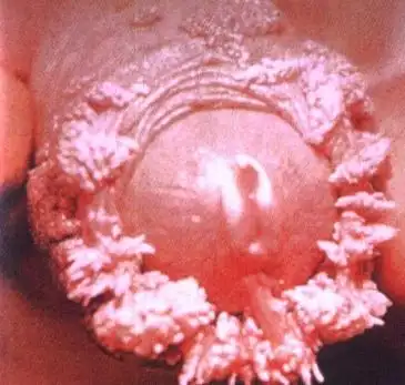 尖锐湿疣早期症状图片(2)