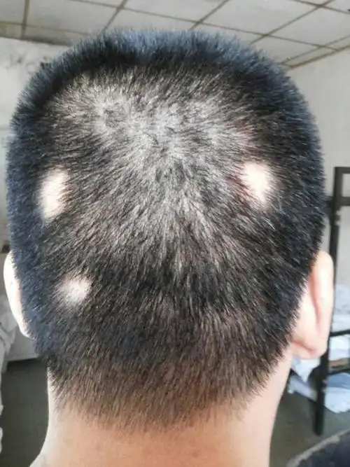 一夜觉起来,头发掉成这样.到底是怎么回事?有什么方法医治好?