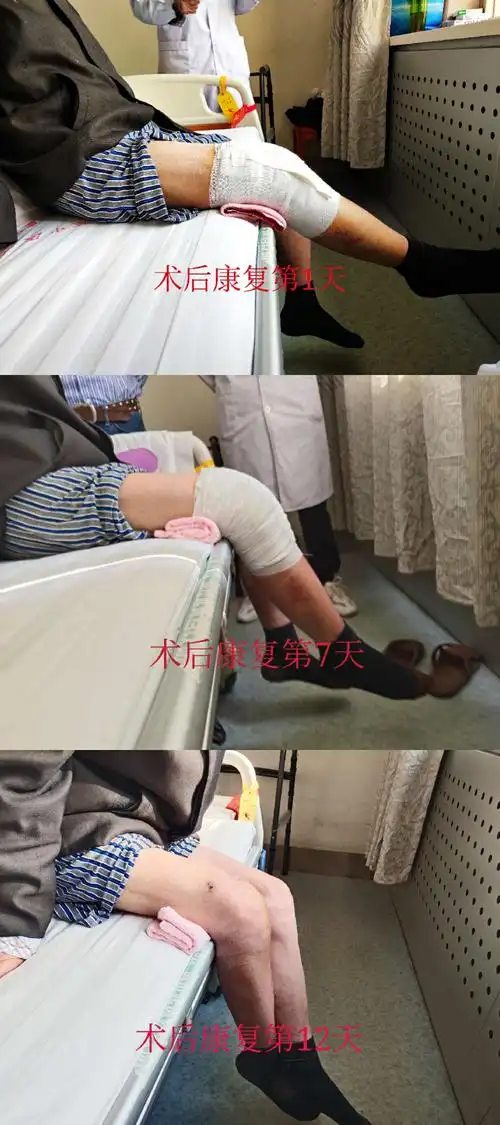 侧腿搭在患腿上下压,完了徒手行膝关节被动屈曲练习,每次弯曲到最大角