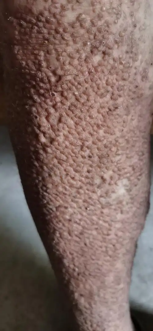 复旦华东皮肤石磊 的想法: 皮肤淀粉样变治疗较为棘手,严重影响美观