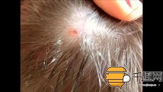 男子头上竟寄生了一直大蛆虫!慎入,小心会吐!