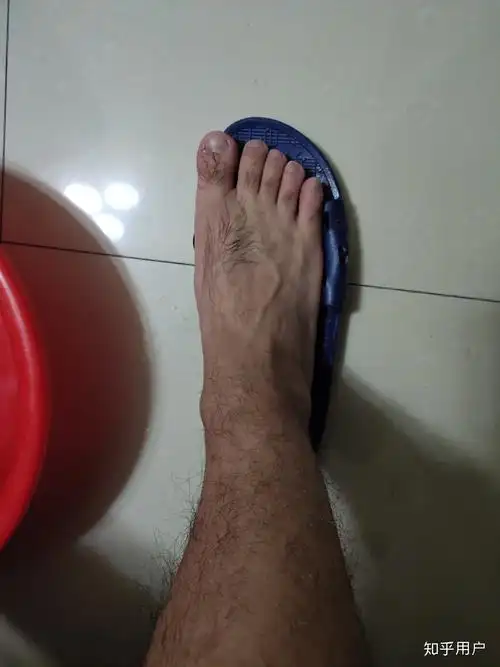 男生腿毛浓密怎么办