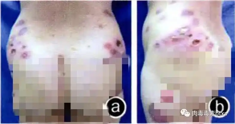 年度最惨 | 注射溶脂针之后,屁股都烂了?