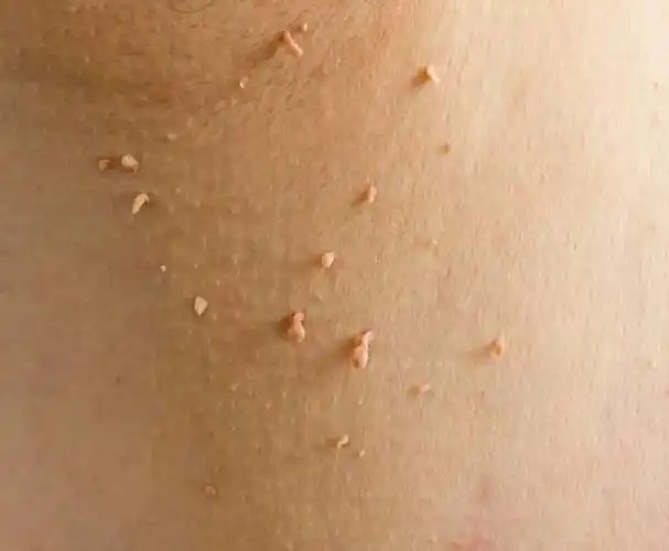 脖子上长这种小肉粒,不是普通皮肤病,可能感染了hpv!