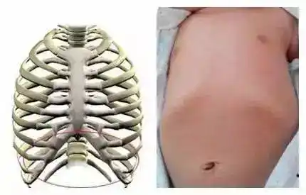 宝宝肋骨外翻家长别太担心,教你如何纠正,预防!