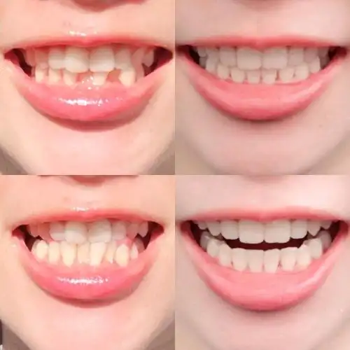 7个月搞定,再也不用担心美观和牙齿刷不干净的问题啦