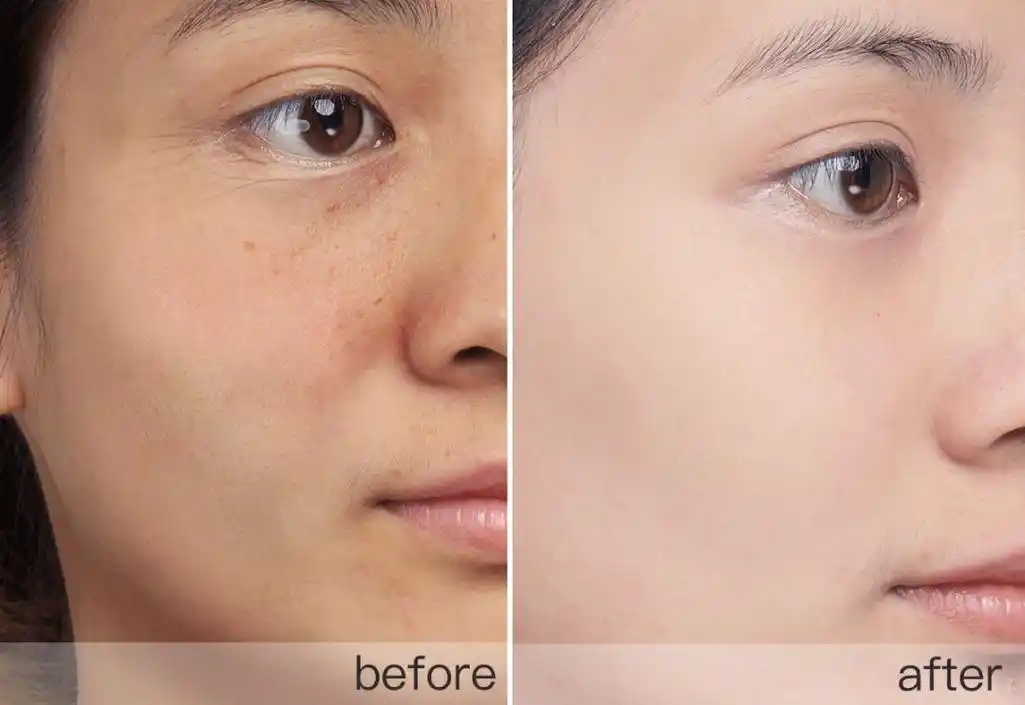 美白祛斑产品排行榜10强,盘点榜单前三:哪种淡斑产品最有效?