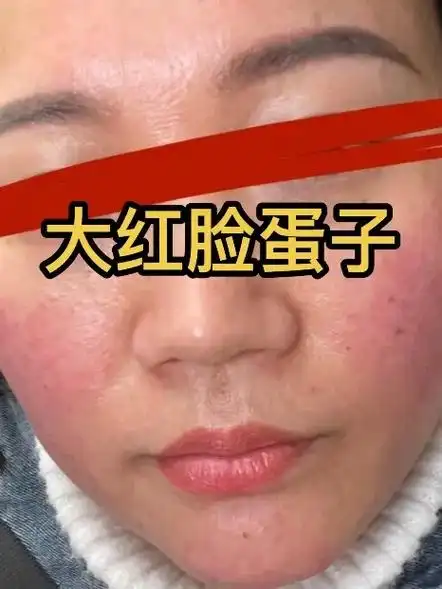 多红的大红脸蛋子用对产品用对方法都能下来! - 抖音