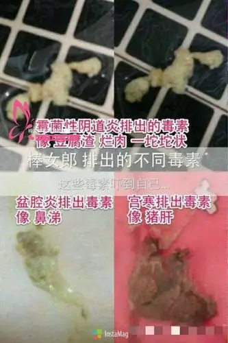 妇科疾病常见症状