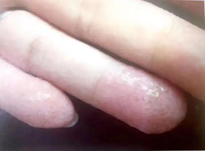 身上的这种小红点是病毒感染,小心越长越多|痤疮|湿疹|荨麻疹|毛囊炎