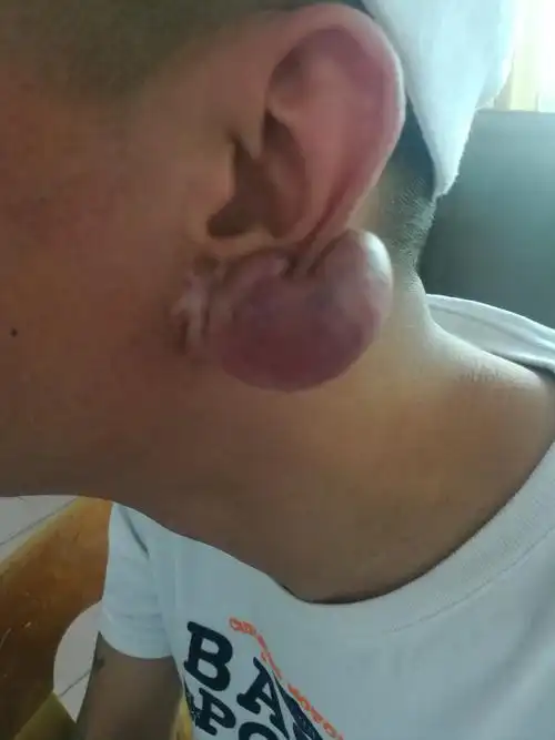 巨大耳廓瘢痕疙瘩一例